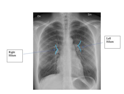 longhili|Imaging of Hila and Pulmonary Vessels 